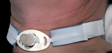Tracheostomy Tube Holder AirLife® Neonatal / Pediatric